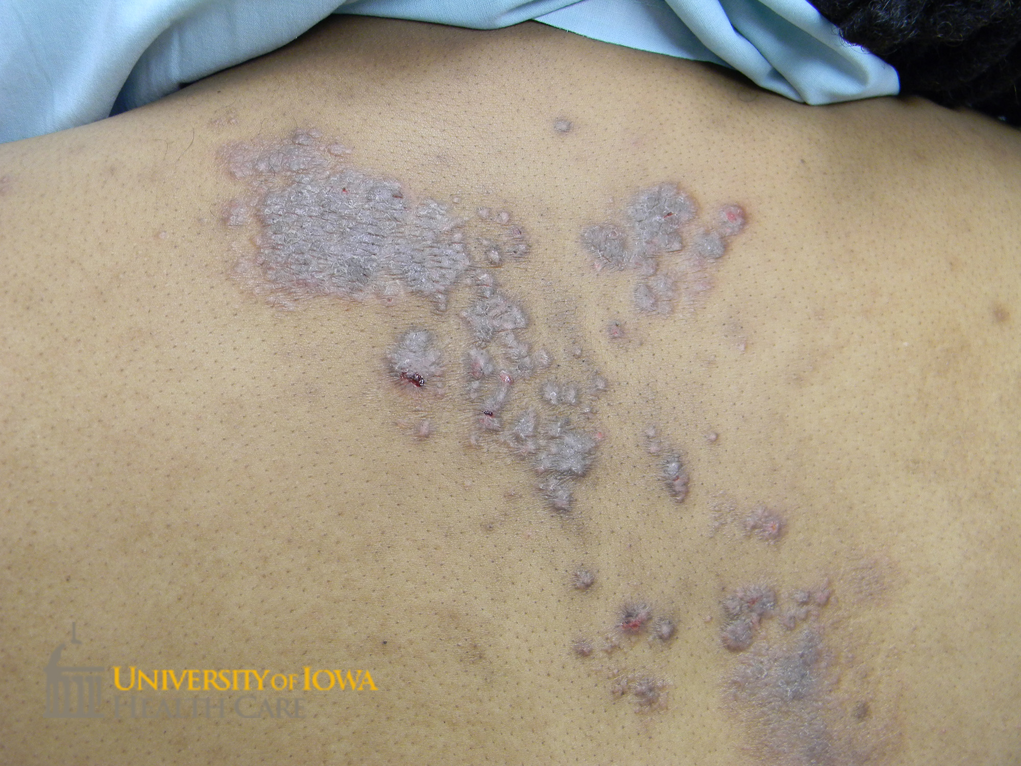 Grouped and confluent cloudy hyperpigmented vesicles and papules in a dermatomal distribution on the upper back. (click images for higher resolution).